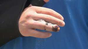 Snake bite